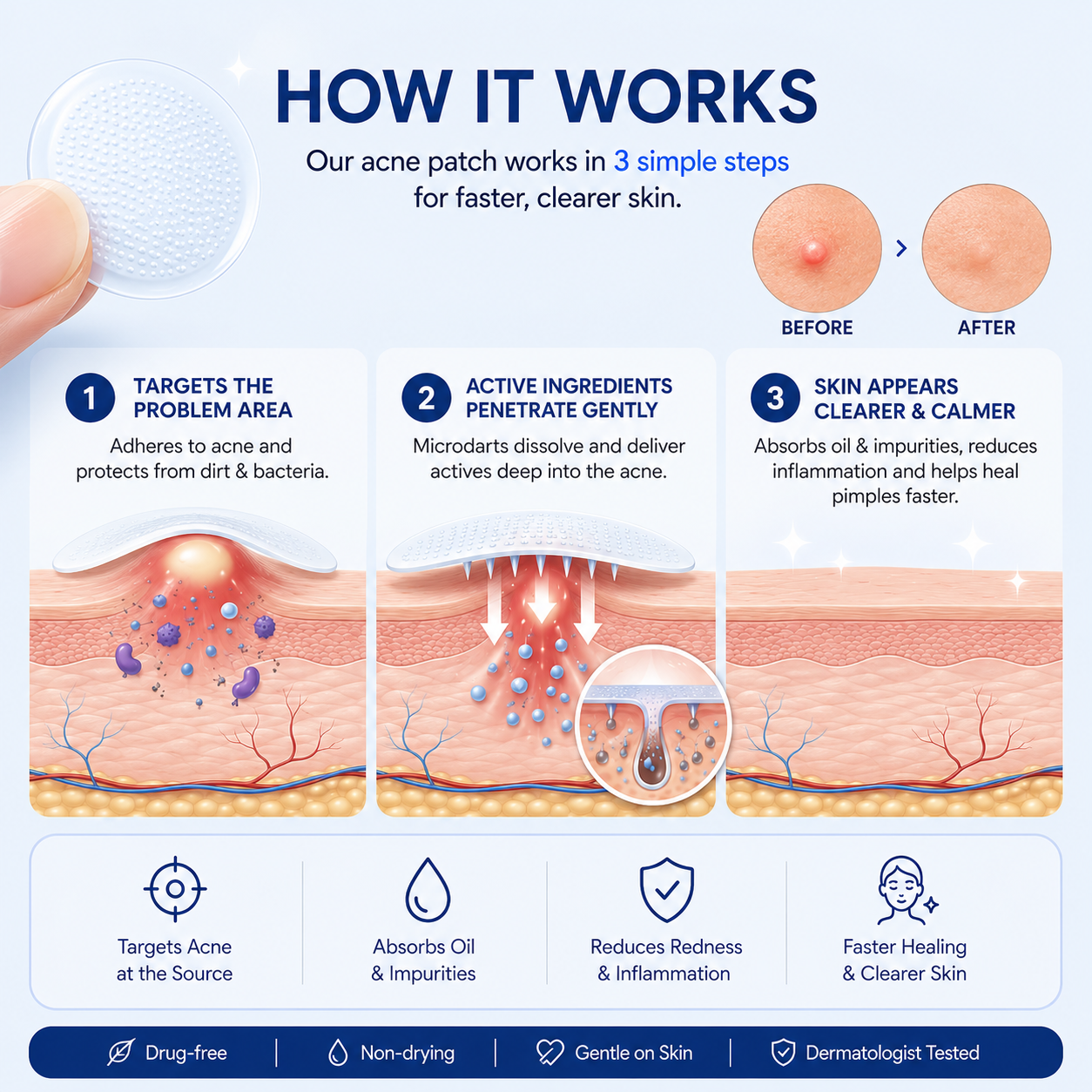 PimpleOut – Invisible Acne Patch